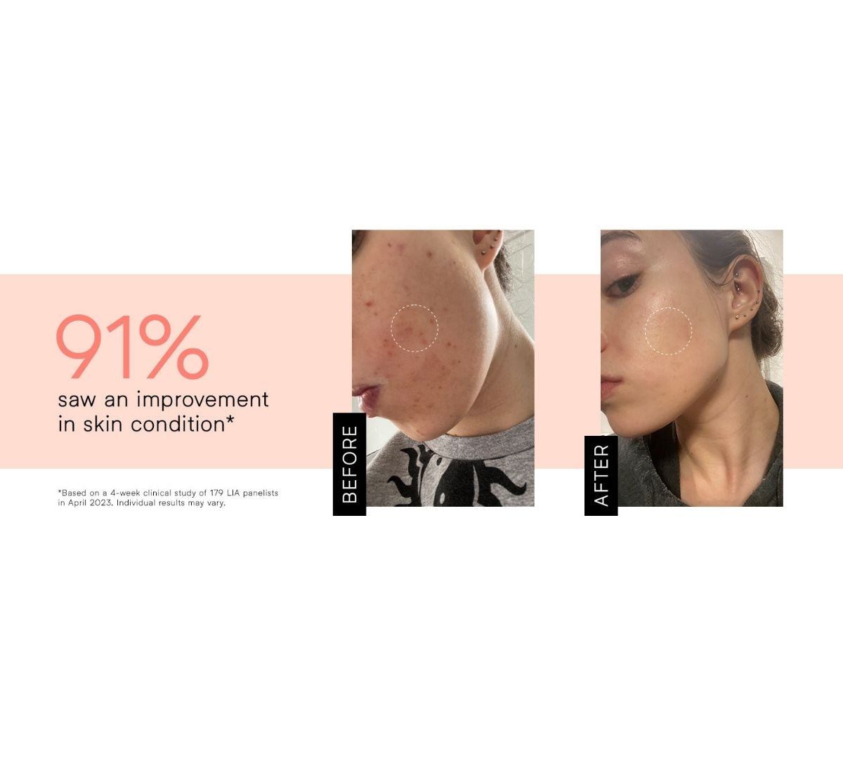Clear Skin Method Bundle – Heal Acne Inside & Out
